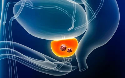 Radiografía del cáncer de próstata en España, según el Dr. Peinado