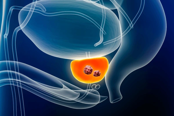 Radiografía del cáncer de próstata en España, según el Dr. Peinado